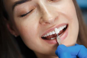 Dental bonding vs. Veneers
