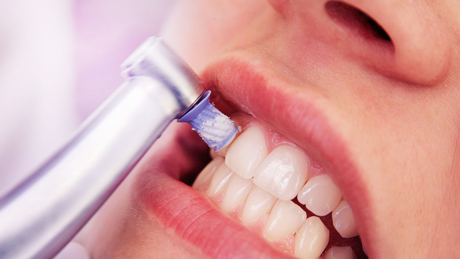 Learn How To Remove Tartar From Your Teeth Without A Dentist