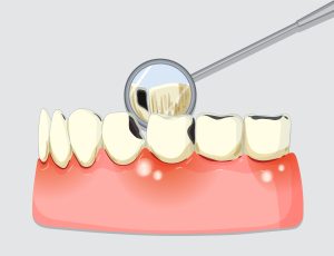 Receding Gums