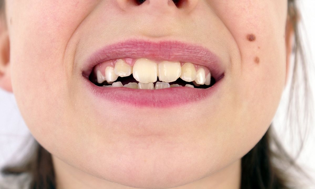 Bottom Teeth Are Crooked