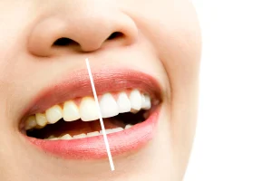 3 Types of Teeth Stains & How to Remove Them?