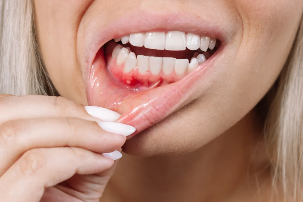 can gum disease be cured