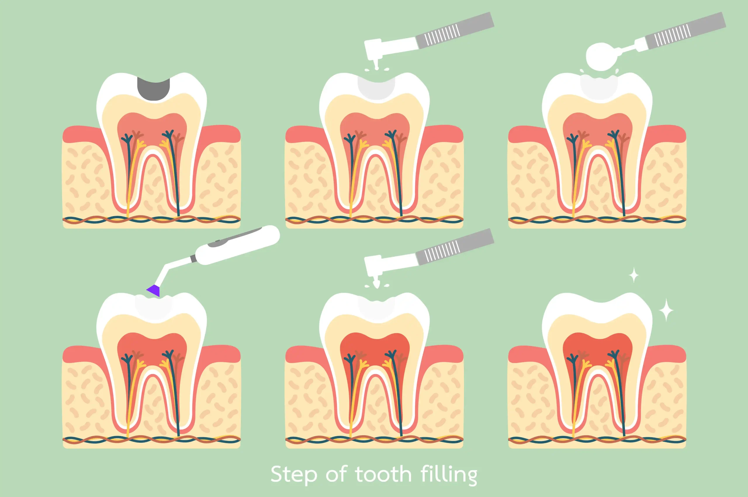 Tooth Filling Houston, TX | Smile4Ever Family Dentistry