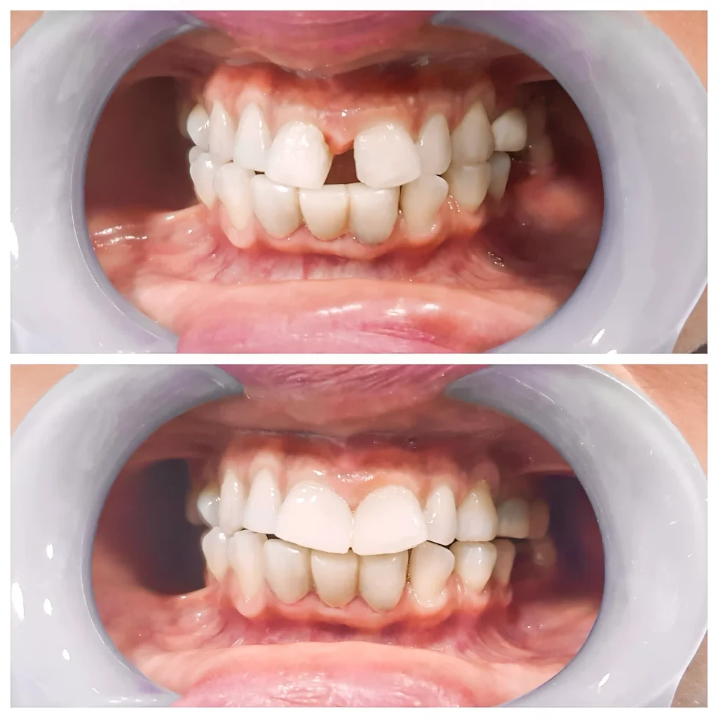 how long does bonding last on front teeth