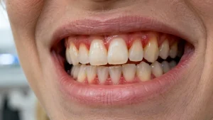 what does gum disease look like